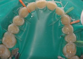 Riabilitazione completa in composito in una seduta, con rialzo della dimensione verticale in pazienti con estese abrasioni dentali