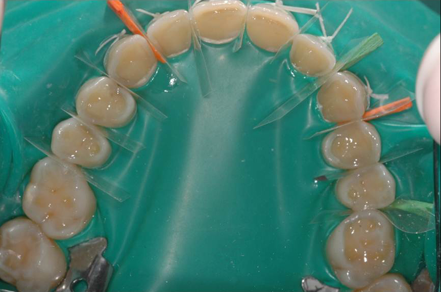 Riabilitazione completa in composito in una seduta, con rialzo della dimensione verticale in pazienti con estese abrasioni dentali